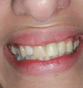 Case Study - Cosmetic Dentistry Before Image