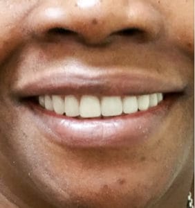 Case Study - Cosmetic Dentistry After Image