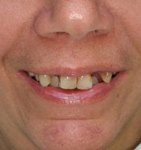 Case Study - Cosmetic Dentistry Before Image