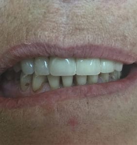 Case Study - Cosmetic Dentistry After Image