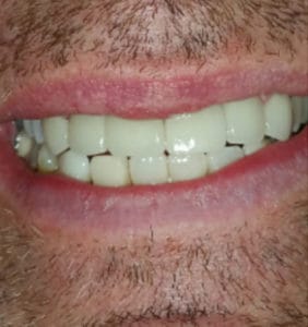 Case Study - Cosmetic Dentistry After Image