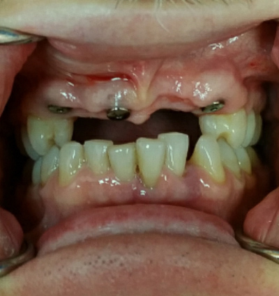 Dental Implants – Case 3