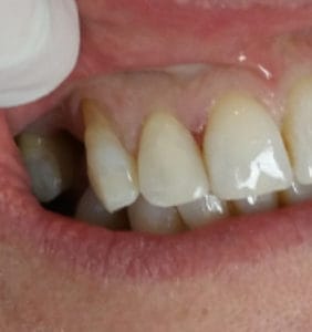 Case Study - Cosmetic Dentistry After Image