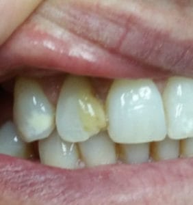 Case Study - Cosmetic Dentistry Before Image