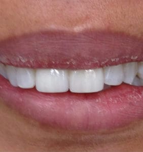 Case Study - Cosmetic Dentistry After Image
