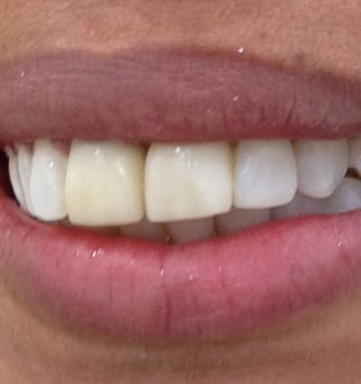 Porcelain Veneers – Case 4