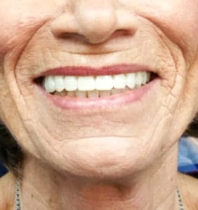 Case Study - Cosmetic Dentistry After Image