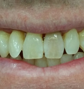 Case Study - Cosmetic Dentistry Before Image