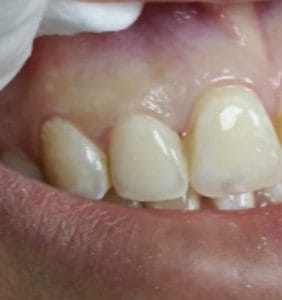 Case Study - Cosmetic Dentistry After Image