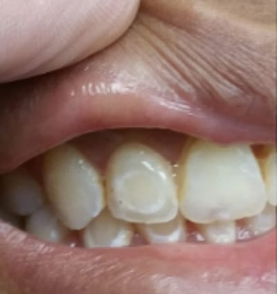 Cosmetic Dentistry – Case 5