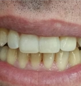 Case Study - Cosmetic Dentistry After Image