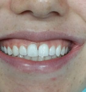 Case Study - Cosmetic Dentistry After Image