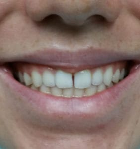 Case Study - Cosmetic Dentistry Before Image