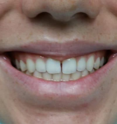 Cosmetic Dentistry – Case 6