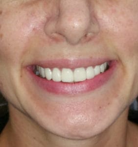 Case Study - Cosmetic Dentistry After Image