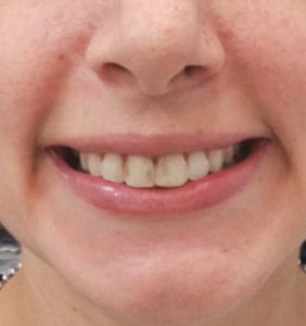 Case Study - Cosmetic Dentistry Before Image