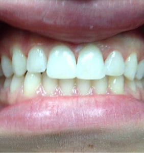 Case Study - Cosmetic Dentistry After Image