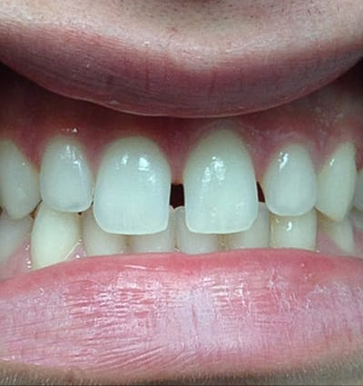 Cosmetic Dentistry – Case 7