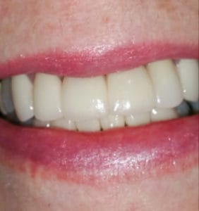 Case Study - Cosmetic Dentistry After Image