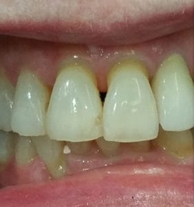 Case Study - Cosmetic Dentistry Before Image