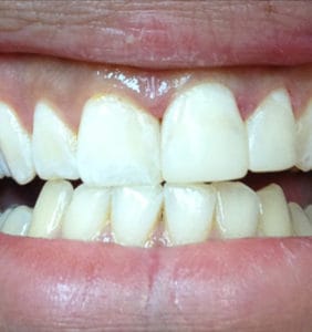 Case Study - Cosmetic Dentistry After Image