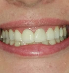 Case Study - Cosmetic Dentistry After Image