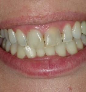 Case Study - Cosmetic Dentistry Before Image