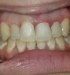 Case Study - Cosmetic Dentistry After Image