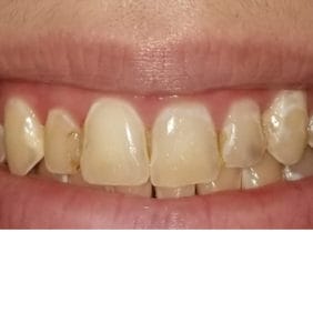 Case Study - Cosmetic Dentistry Before Image