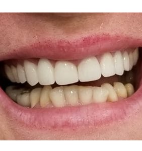 Case Study - Cosmetic Dentistry After Image