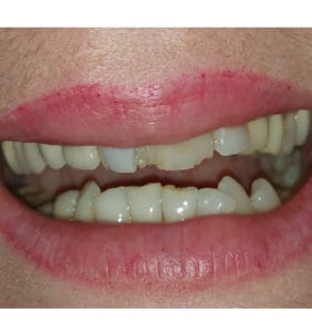 Case Study - Cosmetic Dentistry Before Image