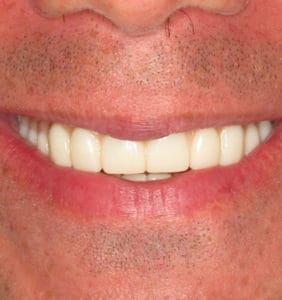 Case Study - Cosmetic Dentistry After Image