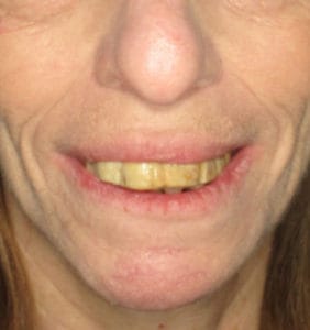 Case Study - Cosmetic Dentistry Before Image