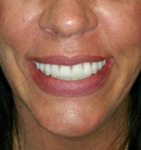 Case Study - Cosmetic Dentistry After Image