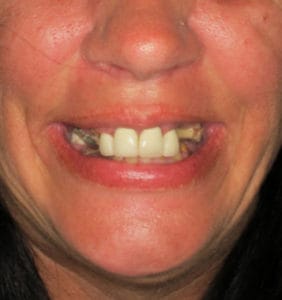 Case Study - Cosmetic Dentistry Before Image