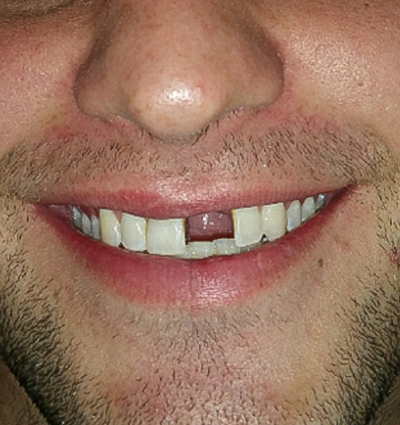 Dental Implants – Case 11