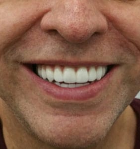 Case Study - Cosmetic Dentistry After Image