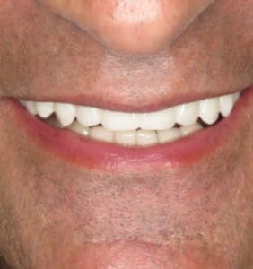 Case Study - Cosmetic Dentistry After Image