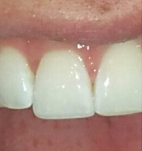 Case Study - Cosmetic Dentistry After Image