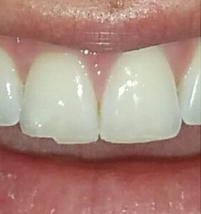 Cosmetic Dentistry – Case 19