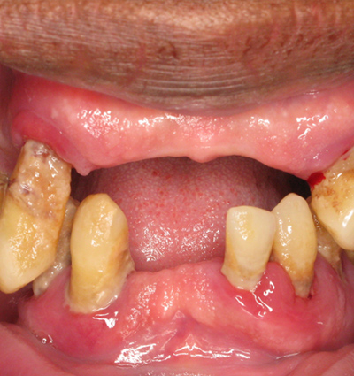 Dental Implants – Case 2