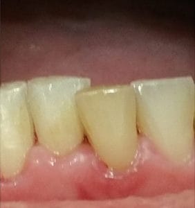 Case Study - Cosmetic Dentistry Before Image