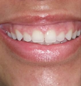 Case Study - Cosmetic Dentistry After Image