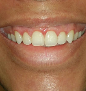 Case Study - Cosmetic Dentistry Before mage