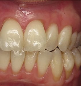 Case Study - Cosmetic Dentistry After Image
