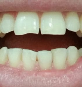 Case Study - Cosmetic Dentistry After Image