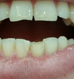 Case Study - Cosmetic Dentistry Before Image