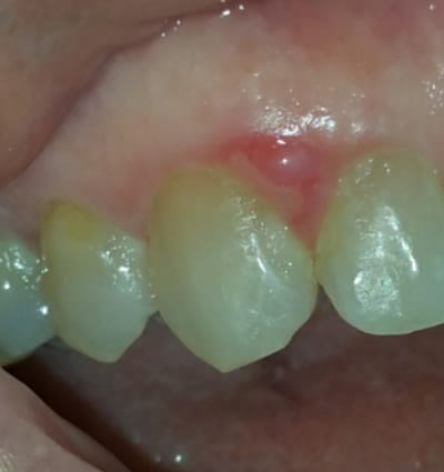 Laser Smile Correction – Case 3