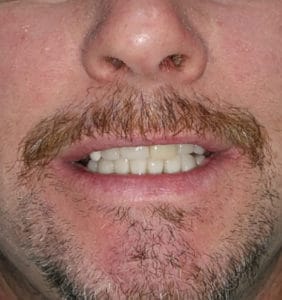 Case Study - Cosmetic Dentistry After Image