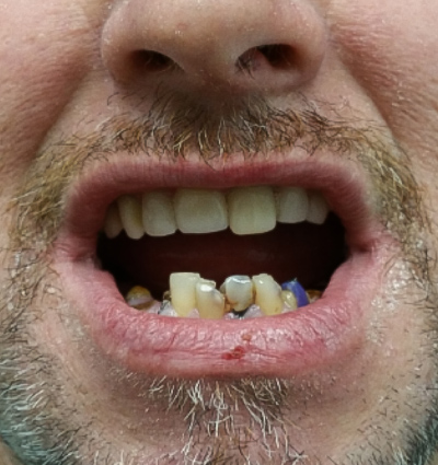 Dental Implants – Case 5